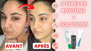 LACNÉ  MA ROUTINE SKINCARE  TOUTES LES SOLUTIONS POUR CHAQUE TYPE DE BOUTON [upl. by Lund]