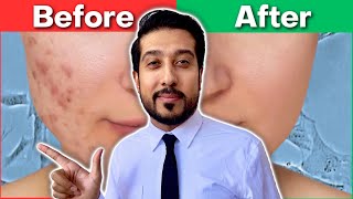 How to Get Rid of EVERY Type of Acne Scar  The Acne Scar ULTIMATE GUIDE [upl. by Ronoc]