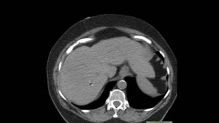 CT Abdomen Epiploic Appendagitis and anatomy [upl. by Jonie383]