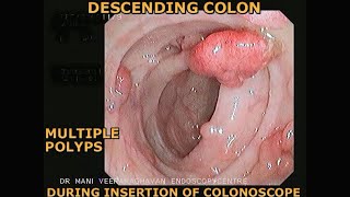 COLON POLYPS  COLONOSCOPY SHOWS MULTIPLE POLYPS  FAMILIAL ADENOMATOUS POLYPOSIS FAP [upl. by Clarance]