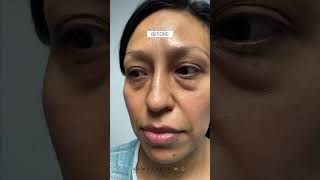 Quadfecta Lift with Dr Parsa  Ethnic Skin Tone  2 Months PostOp [upl. by Origra]