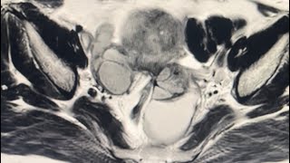 MRI Female Pelvis 37YF  Nabothian cyst [upl. by Nomrac]