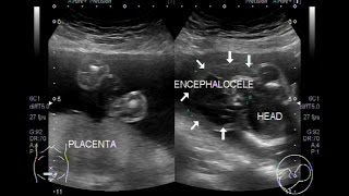 Ultrasound Video showing multiple fetal anomalies [upl. by Arrakat]