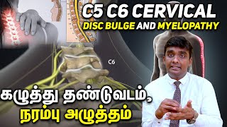 C5 C6 Cervical Disc Bulge and Myelopathy கழுத்து தண்டுவடம் நரம்பு அழுத்தம் Part 1 [upl. by Heloise609]