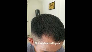 Minoxidil for hair loss liquid VS foam [upl. by Ainecey]