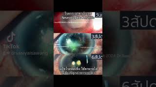 neurotrophic keratitis [upl. by Eileme768]