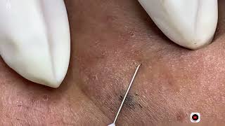 Big Cystic Acne Blackheads Extraction Blackheads amp Milia Whiteheads Removal Pimple Popping [upl. by Rovelli91]