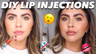 DIY LIP INJECTIONS Natural affordable amp easy [upl. by Nebra120]