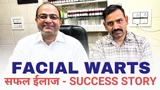 Facial Warts  Success Story  By Dr Rawat Choudhary [upl. by Allisurd42]