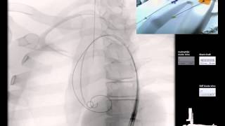 Mentice  Thoracic Endovascular Aortic Repair TEVAR Case Video [upl. by Attelrahc704]