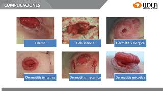 Clase 11 Ostomias y CVC [upl. by Jarlathus639]