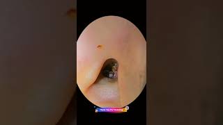 Earwax Removal Part 47 [upl. by Goodhen]