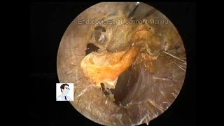 Regular reexamination of cholesteatoma of middle ear after operation [upl. by Sorenson]