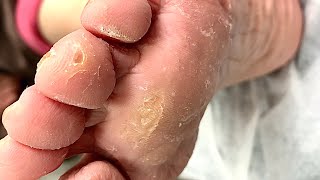 Callus removal from feetampFoot scraping dead skin【Xiao Yan pedicure】stress 40 [upl. by Llerrod31]