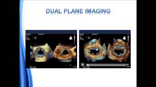 Guidelines for Performing a Comprehensive Transesophageal Echocardiographic Examination [upl. by Amlet]