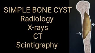 Simple bone cyst Radiology x ray CT and Scintigraphy [upl. by Muna]