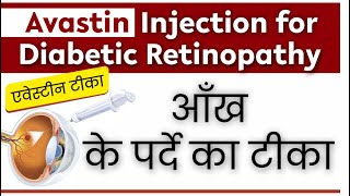 How Avastin Injection Helps Save Vision A CostEffective Solution  AvastinInjection [upl. by Hebert803]