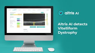 AI detects Vitelliform Dystrophy on OCT [upl. by Ahsanat]