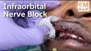 Infraorbital Nerve Block [upl. by Aldredge]