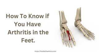 How To Know If You Have Arthritis in Your Feet [upl. by Stephens]