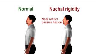 Nuchal rigidity  pathognomonic sign of meningeal irritation [upl. by Anwat]