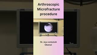 Need Knee Pain Relief Heres What You Should Know About Microfracture Surgery for Early Arthritis [upl. by Enoryt]