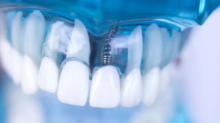 Preventing Periodontal Disease  How Can You Protect Your Gums [upl. by Eimme]