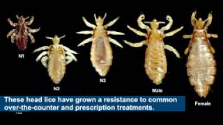 Household product safely cures drug resistant head lice [upl. by Tareyn530]