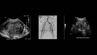 Fibroid on ultrasound post uterine artery embolization [upl. by Asim]