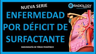 Qué es la enfermedad por DEFICIT DE SURFACTANTE  ¿Enfermedad de MEMBRANA HIALINA 🫁 [upl. by Riebling]