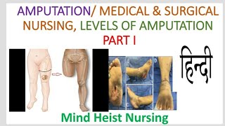 Amputation 《Medicat ampSurgical PART I》 Explained In Hindi [upl. by Ovid871]