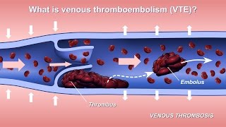 Understanding and Diagnosing Venous Thromboembolism VTE [upl. by Reagen]