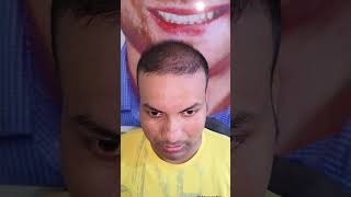 My Hair Transplant Results After 2 Months hairtransplant hairtransplantresults [upl. by Issak]