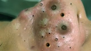 Big Cystic Acne Blackheads Extraction Blackheads amp Milia Whiteheads Removal Pimple Popping  9250 [upl. by Hull690]