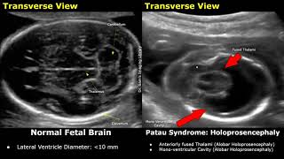 Fetal Ultrasound Normal Vs Patau Syndrome Imaging Findings  Holoprosencephaly amp Other Abnormalities [upl. by Alanson284]