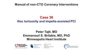 Case 36 PCI Manual  Challenges with Impellaassisted PCI [upl. by Nimesay]