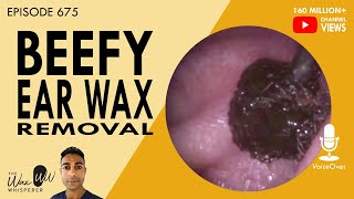 675  Beefy Ear Wax Removal [upl. by Felicle]