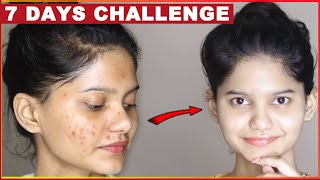 My SPOTS REMOVAL JOURNEY  ACNE SCARS DARK SPOTS HYPERPIGMENTATION PIMPLE SPOTS [upl. by Stephenson227]