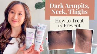 Treating and Preventing Dark Armpits Thighs Neck and Arms  Dr Jenny Liu [upl. by Libbna674]