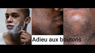 COMMENT TRAITER LES BOUTONS APRES RASAGE [upl. by Ainoz]