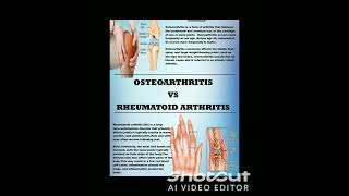 OsteoarthritisOsteoarthritis shorts youtubeshort viral shortfeedclips [upl. by Dever472]