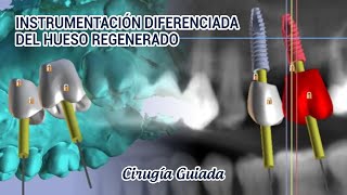 CIRUGIA GUIADA Instrumentación diferenciada del hueso regenerado [upl. by Guinna636]