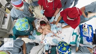 Conjoined twins survive 26hour separation surgery  Mashable [upl. by Leakcim949]