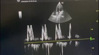 Bedside imageology p2 60F with comorbidities and acute heart failure after covid like viral [upl. by Llij]