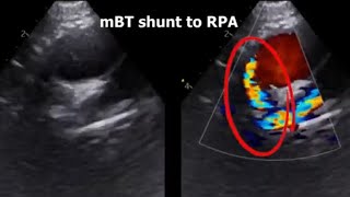 Echo imaging after single ventricle operations [upl. by Lekym885]