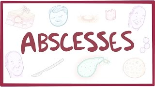 Abscesses  causes symptoms diagnosis treatment pathology [upl. by Blodgett]