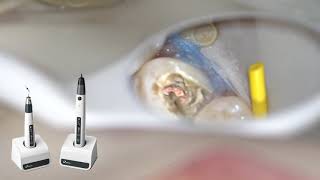 Eighteeth Obturation System  Clinical Case By DrToygan Bora [upl. by Aivekahs]