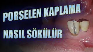 Porselen Kaplama Nasıl Sökülür [upl. by Tecla]