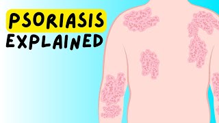 What is Psoriasis Definition Etiology Classification Pathophysiology Diagnosis Treatment [upl. by Oicor]