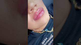 Hyaluron Pen Lips Needle free lip fillers using dermalax deep plus [upl. by Theodore828]